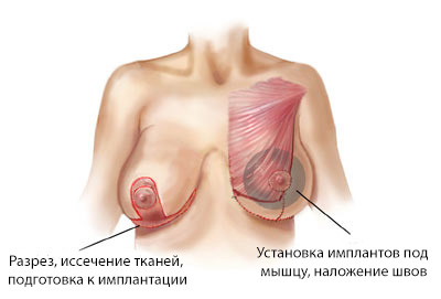 Подтяжка груди с увеличением имплантами в Минске