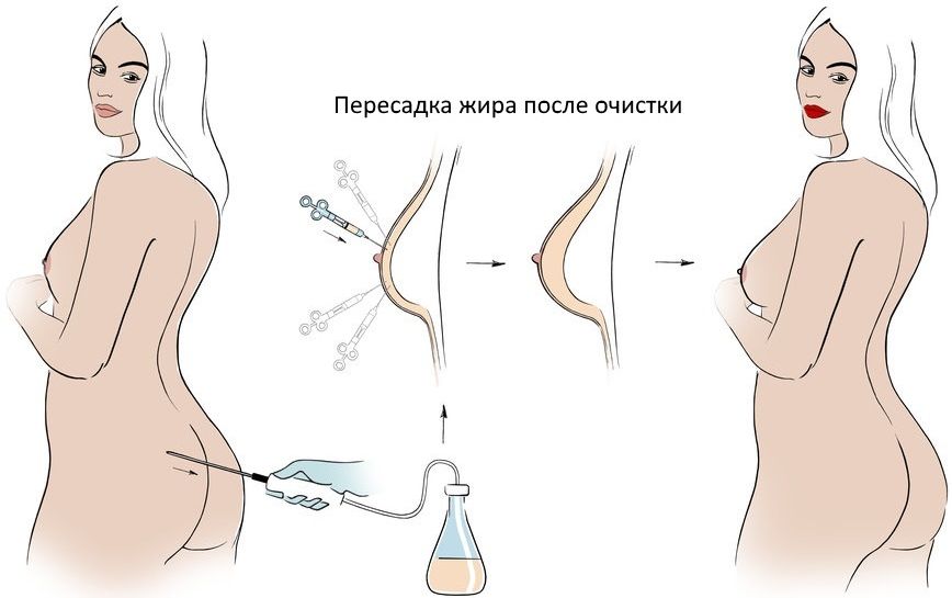 Липофилинг груди в Минске