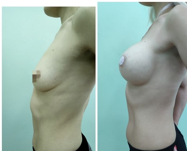 Увеличение груди имплантами в Минске