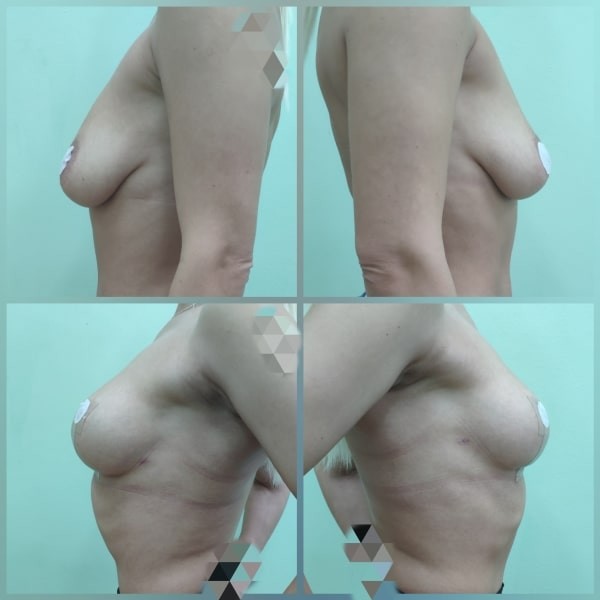 Подтяжка и увеличение груди имплантами