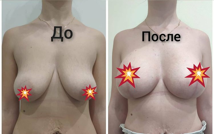 Вертикальная редукция (уменьшение) груди, установка имплантов Motiva Round 380ml, уменьшение ареол, устранение тубулярности груди