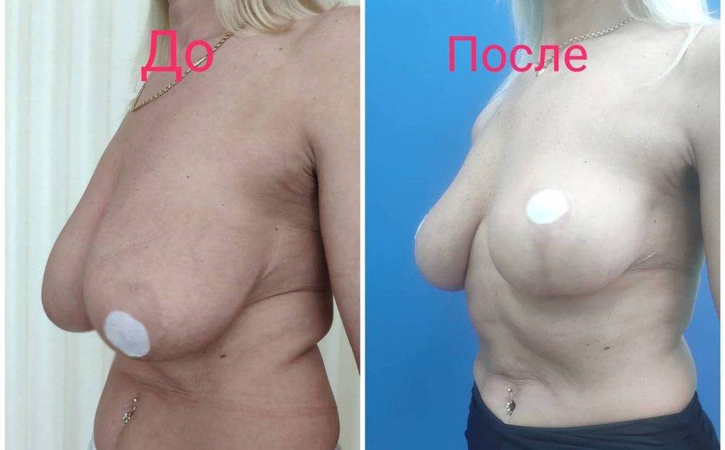 \"Т\"- образная редукционная маммопластика без использования имплантов. После операции прошел 1 год.