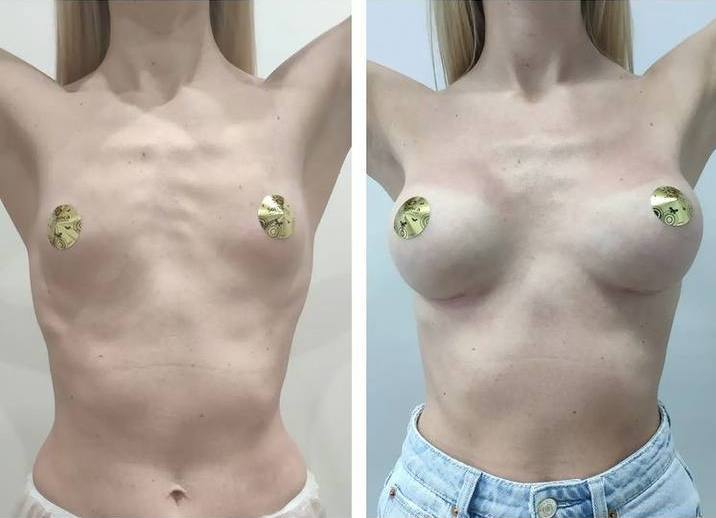 Увеличение груди имплантами в Минске